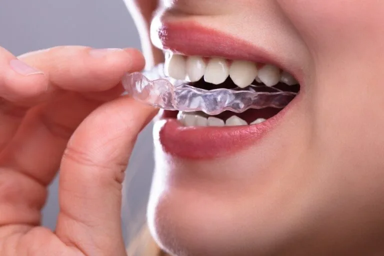 Clear Aligners Malaysia - Sinaran Dental Clinic