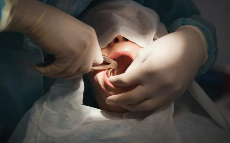 Wisdom Tooth Extraction Malaysia - Sinaran Dental Clinic