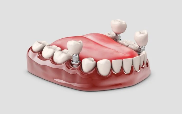 Dental Implant Malaysia - Sinaran Dental Clinic