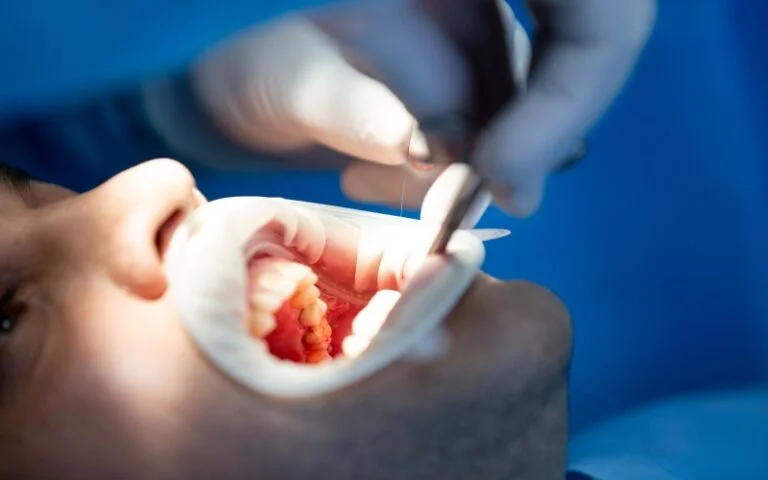 Dental and Tooth Filling Services - Sinaran Dental Clinic