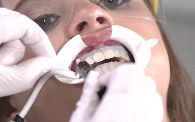 Teeth Whitening Clinic Malaysia - Sinaran Dental Clinic