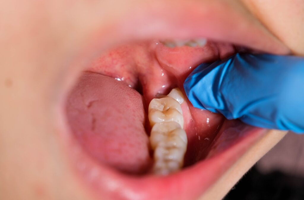 Wisdom Tooth Extraction Malaysia - Sinaran Dental Clinic